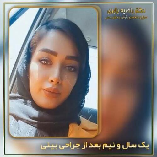 جراحی-زیبایی-بینی-15