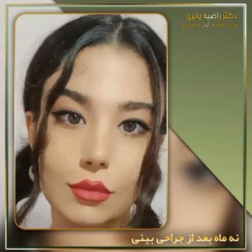 جراحی-زیبایی-بینی-16