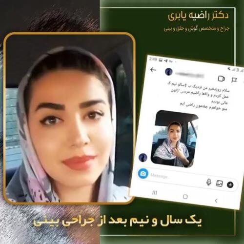 جراحی-زیبایی-بینی-18