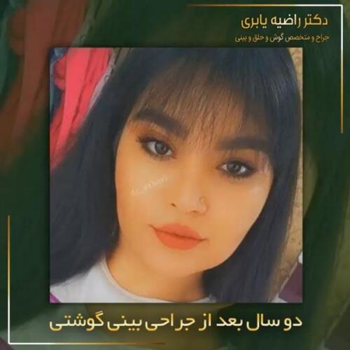 جراحی-زیبایی-بینی-20