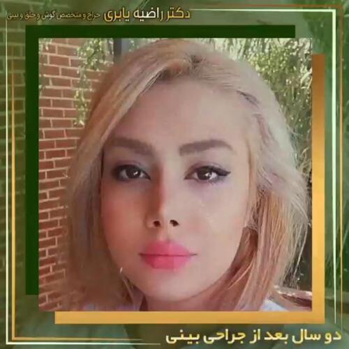 جراحی-زیبایی-بینی-22