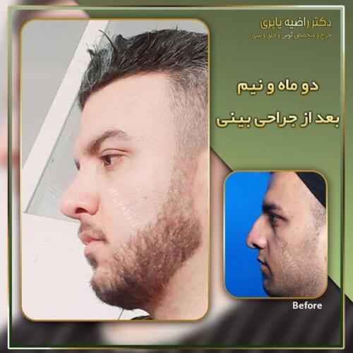 جراحی-زیبایی-بینی-23