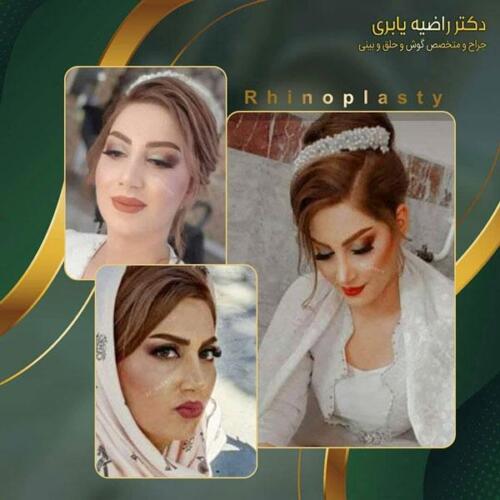 جراحی-زیبایی-بینی-26