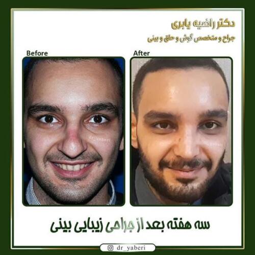 جراحی-زیبایی-بینی-3