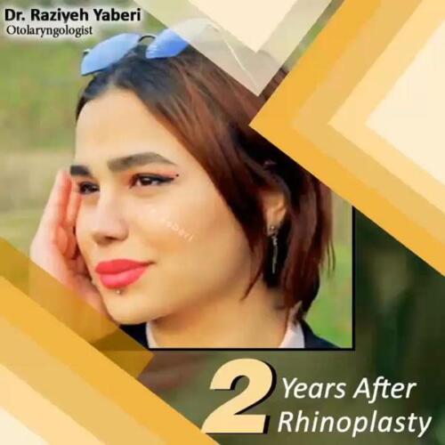 جراحی-زیبایی-بینی-30