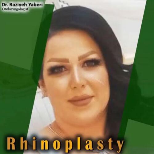 جراحی-زیبایی-بینی-32