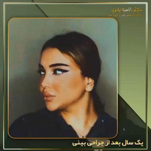 جراحی-زیبایی-بینی-33