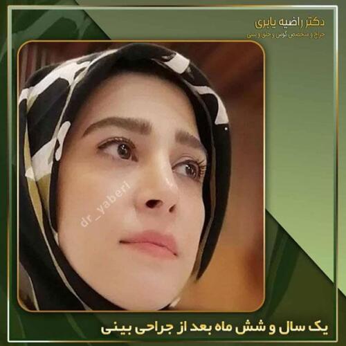 جراحی-زیبایی-بینی-38