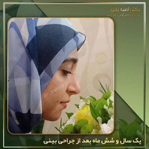 جراحی-زیبایی-بینی-39