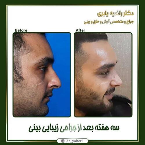 جراحی-زیبایی-بینی-4