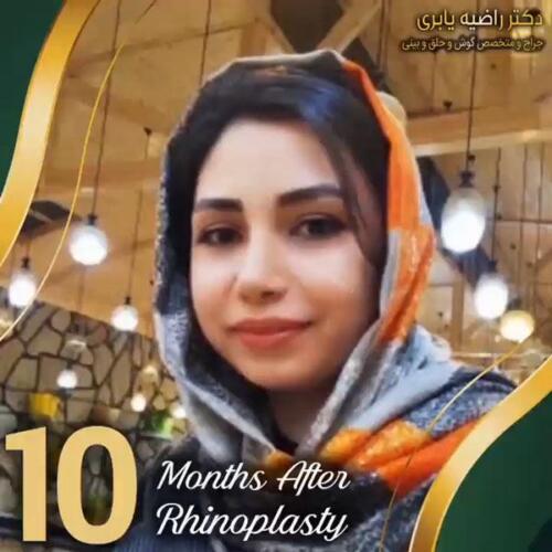 جراحی-زیبایی-بینی-41