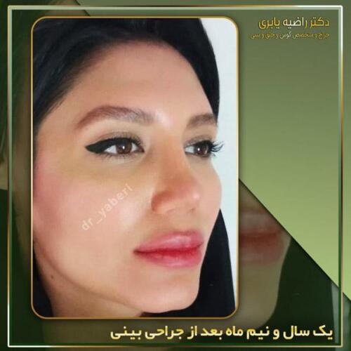 جراحی-زیبایی-بینی-43