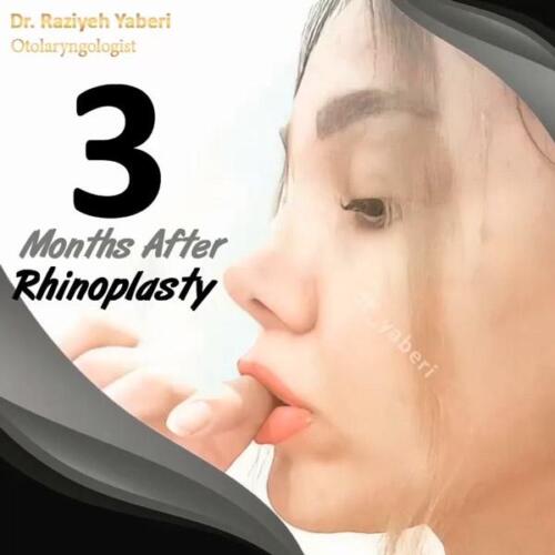 جراحی-زیبایی-بینی-54