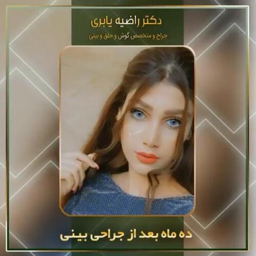 جراحی-زیبایی-بینی-6