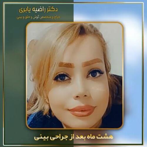جراحی-زیبایی-بینی-9