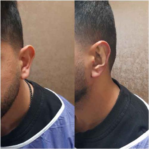 جراحی-گوش-در-تهران-64