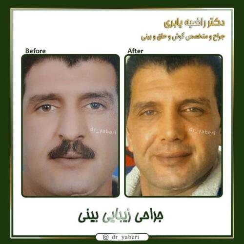 جراحی زیبایی بینی 1