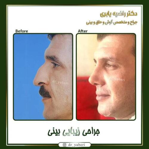 جراحی زیبایی بینی 2