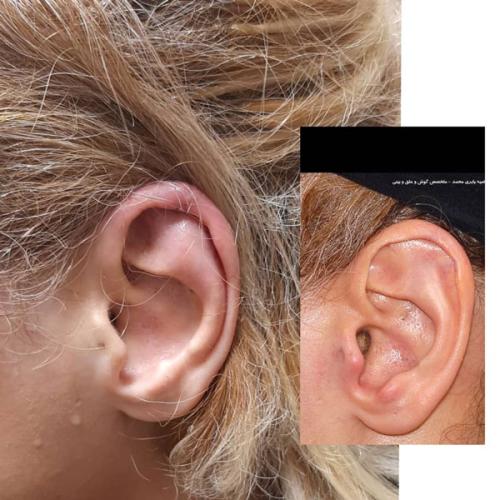 جراحی-گوش-در-تهران-14