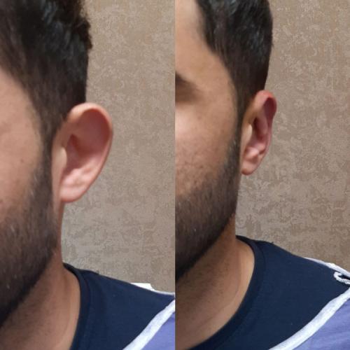 جراحی-گوش-در-تهران-38