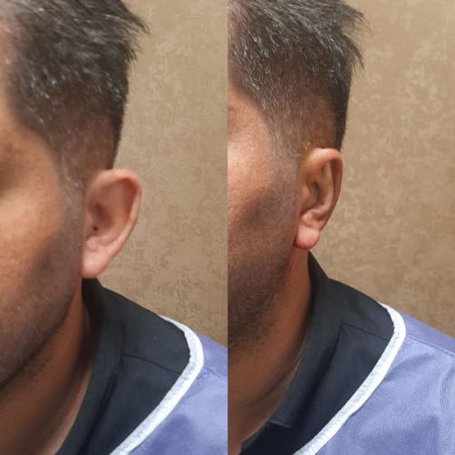 جراحی-گوش-در-تهران-39