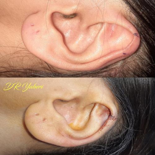 جراحی-گوش-در-تهران-42