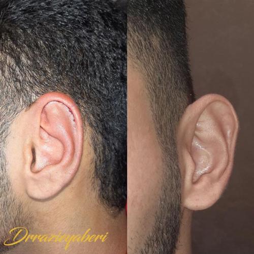 جراحی-گوش-در-تهران-48