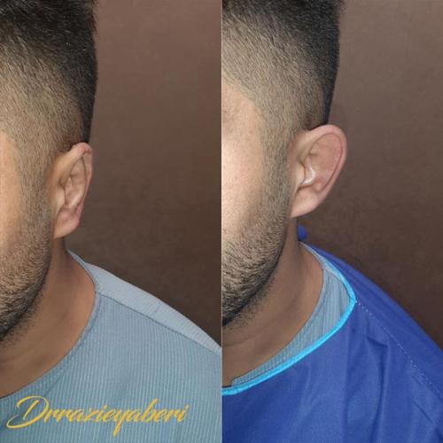 جراحی-گوش-در-تهران-51