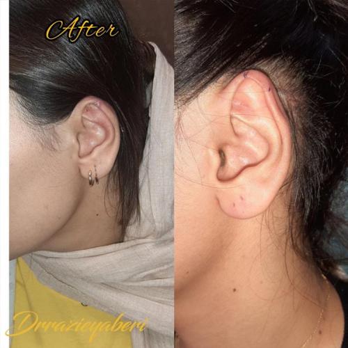 جراحی-گوش-در-تهران-52