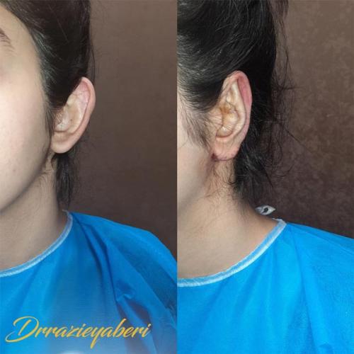 جراحی-گوش-در-تهران-55