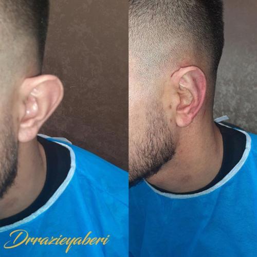جراحی-گوش-در-تهران-56