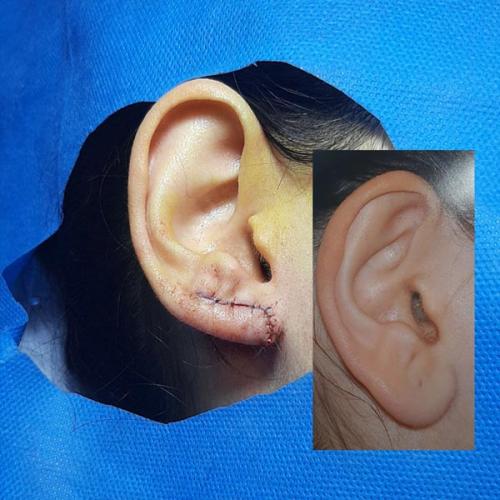 جراحی-گوش-در-تهران12