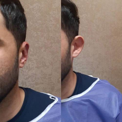 جراحی-گوش-در-تهران16