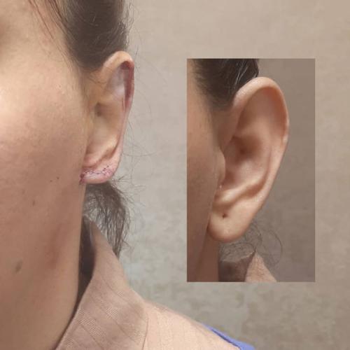 جراحی-گوش-در-تهران17