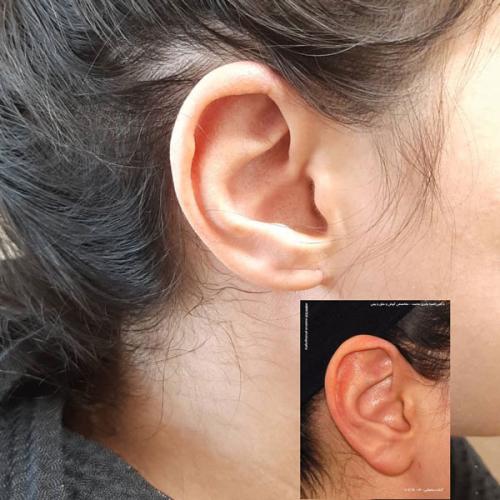 جراحی-گوش-در-تهران23