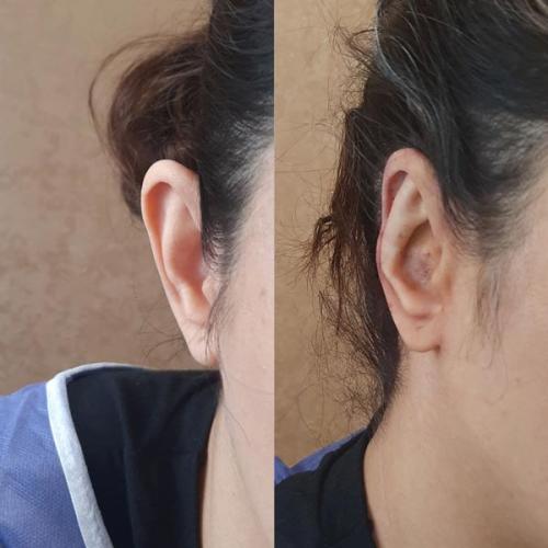 جراحی-گوش-در-تهران26
