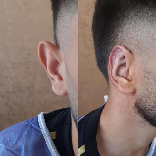 جراحی-گوش-در-تهران27