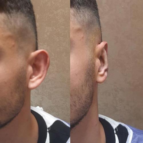 جراحی-گوش-در-تهران28